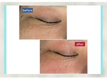 サロン ド メタセコイア(salon de Metasequoia)/筋膜リフト／before☆after