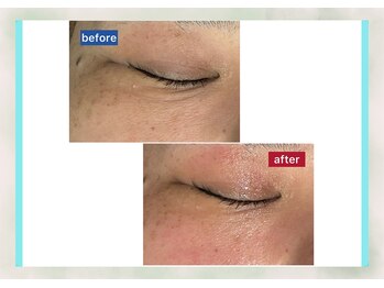 サロン ド メタセコイア(salon de Metasequoia)/筋膜リフト／before☆after