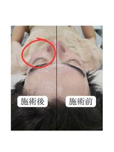 ティンクル サロン(Twinkle salon)/顔全体脱毛