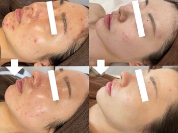 ビースキン 藤沢店(BeSkin)の写真/【皮脂汚れ/シミしわ/ニキビケア】に肌質から改善するハーブピーリング♪繰り返させないニキビケア◎
