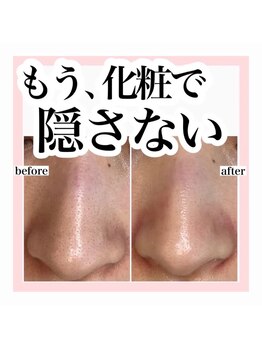 ホワイトアクア 加古川店(WHITE AQUA)/ララピール/兵庫/加古川/毛穴