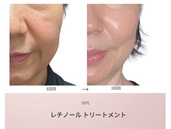 リアン(Lien)/50代 ビフォーアフター