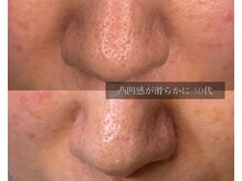 ル シーニュ/凸凹毛穴