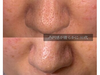 ル シーニュ/凸凹毛穴