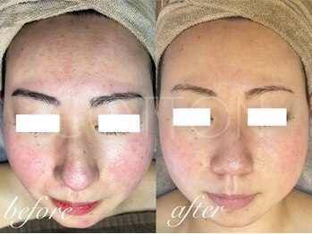 プライベートサロン コットン(COTTON)/肌改善プログラム