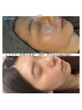 ソア/【ニキビケアH】HAABREPRO1回