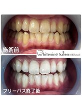 ホワイトニングサロン 京都烏丸店/ホワイトニング施術例