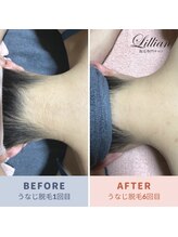 リリアン 周南店(Lillian)/うなじ　before after