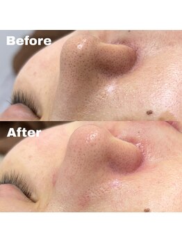 ナインオブカップス(9 of cups)/ハイドロピーリング/毛穴洗浄