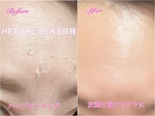 アロマアンドビューティー クリスタルローズ(CRYSTAL ROSE)/ハーブピーリング