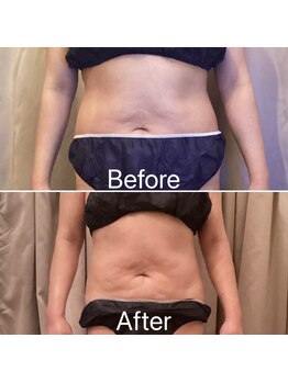 アプローズ(APPLAUSE)/強力なバキューム×インディバ