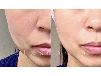 グランデ(Grande)/プラズマでお肌弾力UP◎