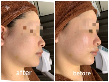 美ネージュの写真/老け見え解消！レッドショット×レモンボトルで根本改善。最新リフトアップでハリツヤ肌