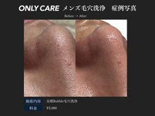 オンリィケア 近大前(ONLY CARE)/【メンズ毛穴洗浄】