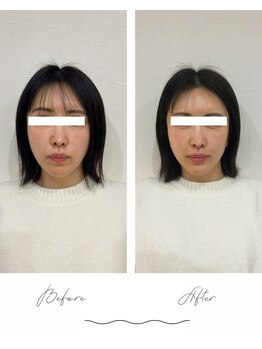マヴィ(mavie)/美顔コースBeforeAfter