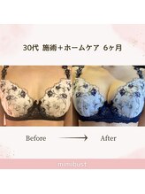ミミバスト(mimibust)/バストアップBeforeAfter