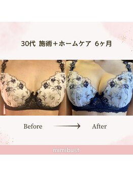 ミミバスト(mimibust)/バストアップBeforeAfter