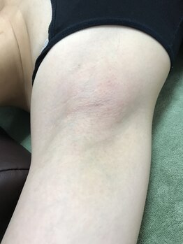 エステサロン オパール(OPALE)/ワキ脱毛6回コース3990円