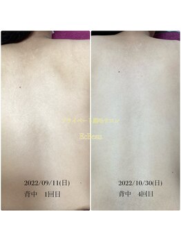 エクボ(EcBeau)/全身脱毛お客様症例写真（背中）