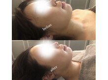 ディライト 名古屋駅店(Delight)/小顔ハイパーナイフモニター