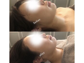 ディライト 名古屋駅店(Delight)/小顔ハイパーナイフモニター