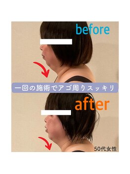モリコ コンフィデントビューティーサロン(Moriko Confident Beauty Salon)/1回の施術で二重アゴスッキリ