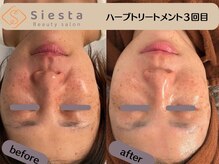 シエスタ(siesta)/剥離なしハーブピーリング３回目