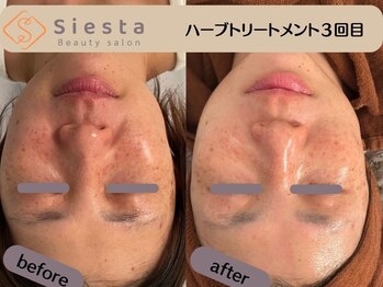 シエスタ(siesta)/剥離なしハーブピーリング３回目