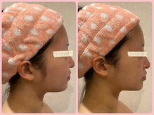 美肌痩身サロン ラエルヴェ(La Elever)/小顔リフトアップ大作戦！