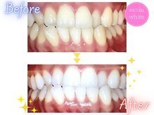 エクシアホワイトニング 高崎店/ビフォーアフター