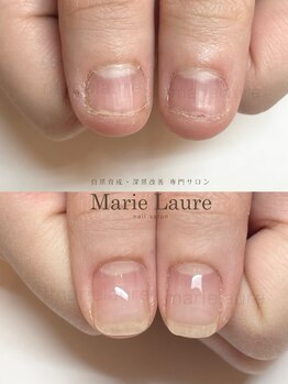 マリーロール 淀屋橋本店(Marie Laure)/自爪育成/深爪矯正/ネイルケア