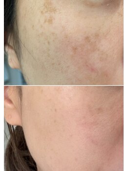 ララ オートクチュール(LALA HAUTOCOUTURE)/産後のシミケア