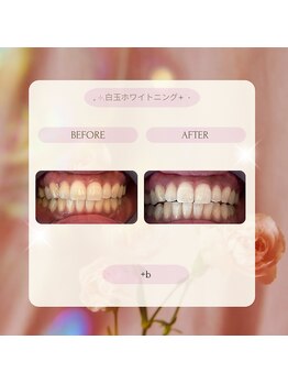 プラスビーセルフ(+b self)/ホワイトニングビフォーアフター