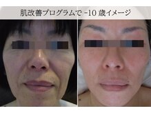 ラグランシエル(Le grand ciel)/肌改善プログラム