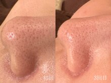 ウォーム(warm)/毛穴/毛穴洗浄/毛穴ケア/毛穴