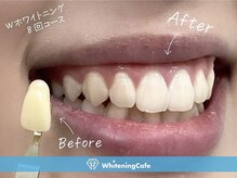 ホワイトニングカフェ 立川店(WhiteningCafe)/◎歯のホワイトニング施術写真◎