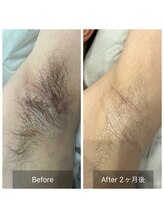 アート 熊本並木坂店(ART)/フラッシュワックス脱毛/両ワキ