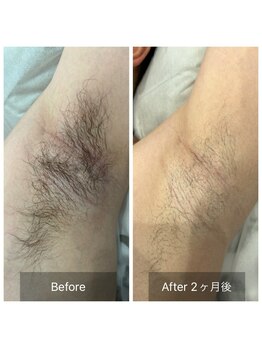 アート 熊本並木坂店(ART)/フラッシュワックス脱毛/両ワキ