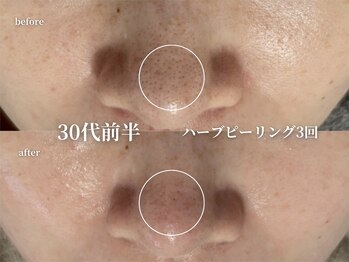 コウル 川西能勢口店(geoul)/毛穴レス美肌コース＋毛穴洗浄