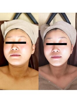 ビューティーサロン アムール(Beauty Salon Amour)/1回3000円の石膏パック!