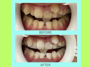 ココティ ホワイトニング(Cocotii)/お客様ビフォーアフター