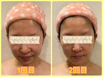 美肌痩身サロン ラエルヴェ(La Elever)/小顔リフトアップ大作戦！ 