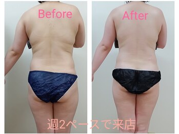 ヨサパーク オリ 境町店(YOSA PARK oli)/20代のお客様結果報告♪エステ