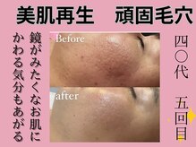 じぶんniプラスの雰囲気（毛穴角質ゼロ　ニキビケア　頑固にアプローチケア）