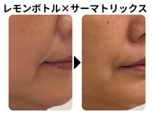 ラディアント たまプラーザ/レモンボトル×サーマトリックス