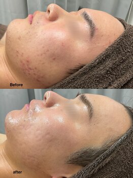 チェルト 鈴鹿店(CERTO)/結果重視のハーブピーリング