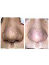 ミント/毛穴コース１度でこの違い