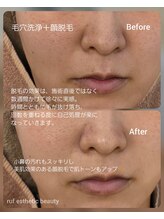 ルフ エステティック ビューティー(ruf esthetic beauty)/毛穴洗浄+顔脱毛