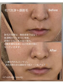 ルフ エステティック ビューティー(ruf esthetic beauty)/毛穴洗浄+顔脱毛
