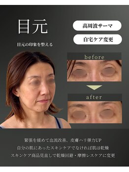 シェリー(Cherie)/目元の窪みを軽減する